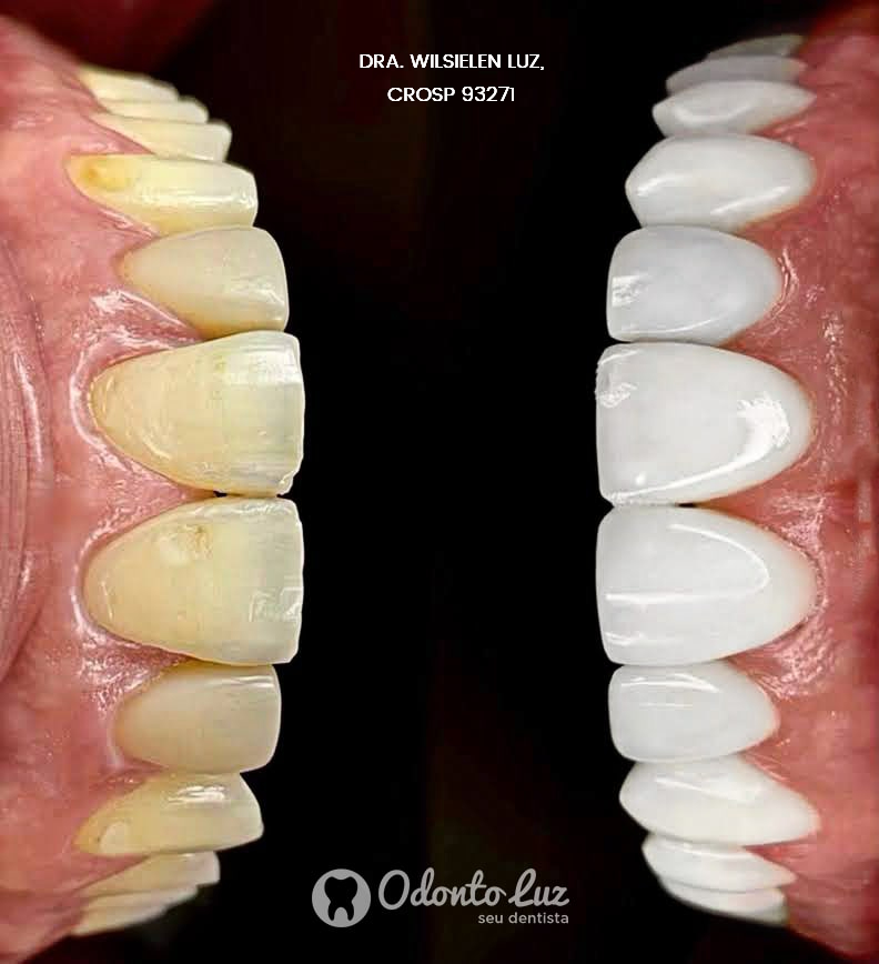 Dra. Wilsielen Luz, cro 93.271, Faceta em resina